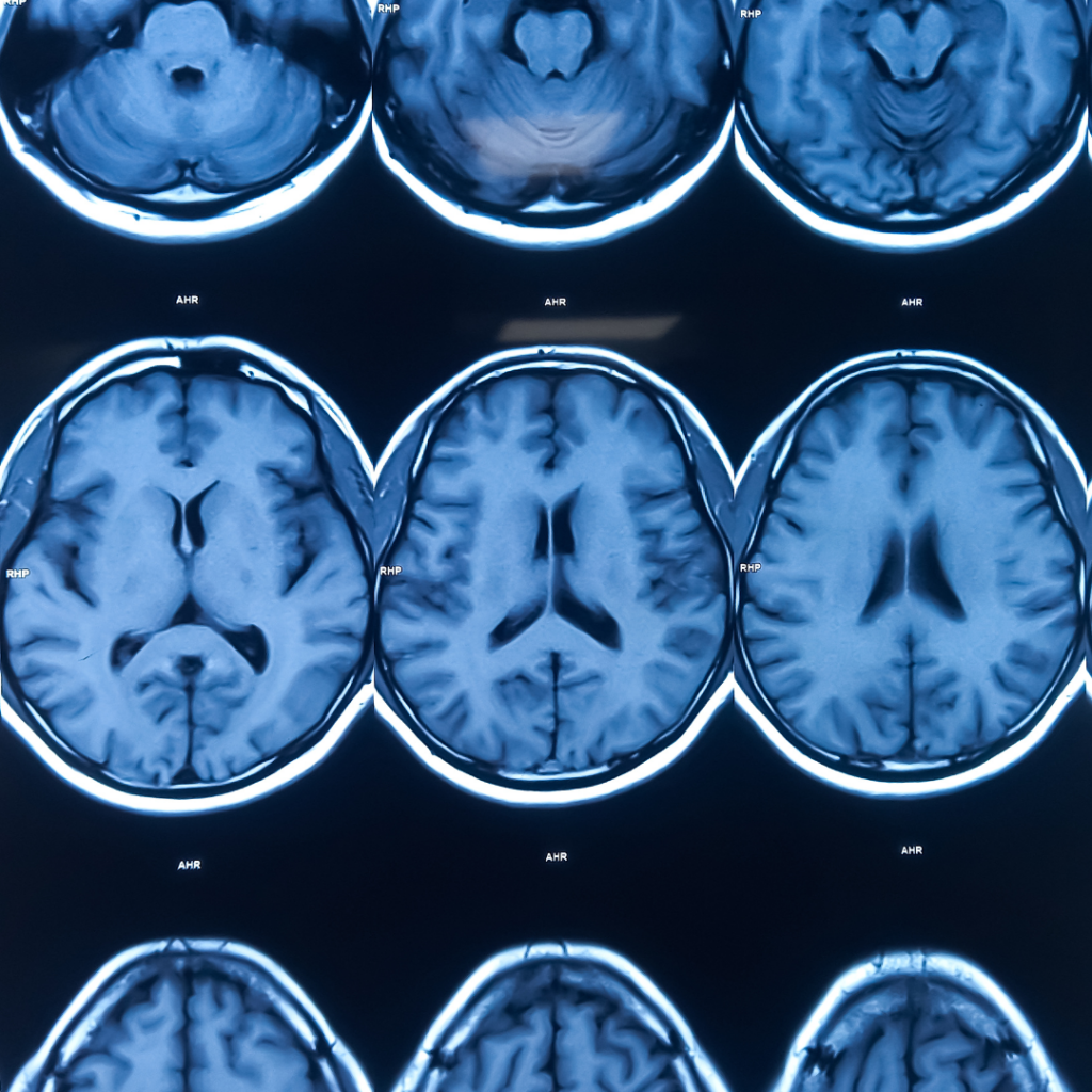 Photos of blue brain scans on a screen